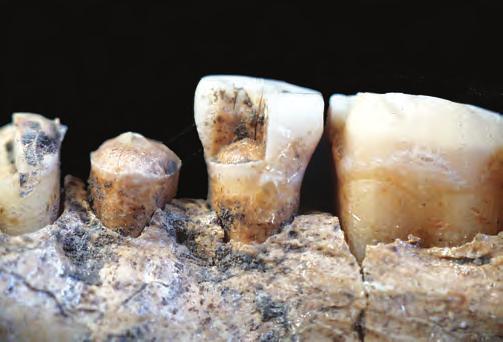 Ritual or Ordinary Burial Rites at the Velim Bronze Age Site? FIGURE 13a. Traces of violent impact on dental crowns P 1, P 2 and M 1. and others).