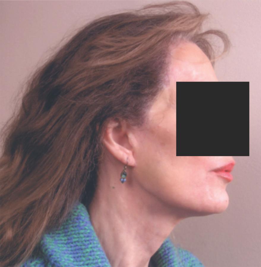 Mohs surgery for skin cancer two years prior hairline