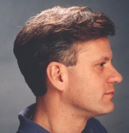 He developed a theory of donor dominance, which states that the thicker hair from the donor area will remain thick once it has been moved to the formerly bald area.