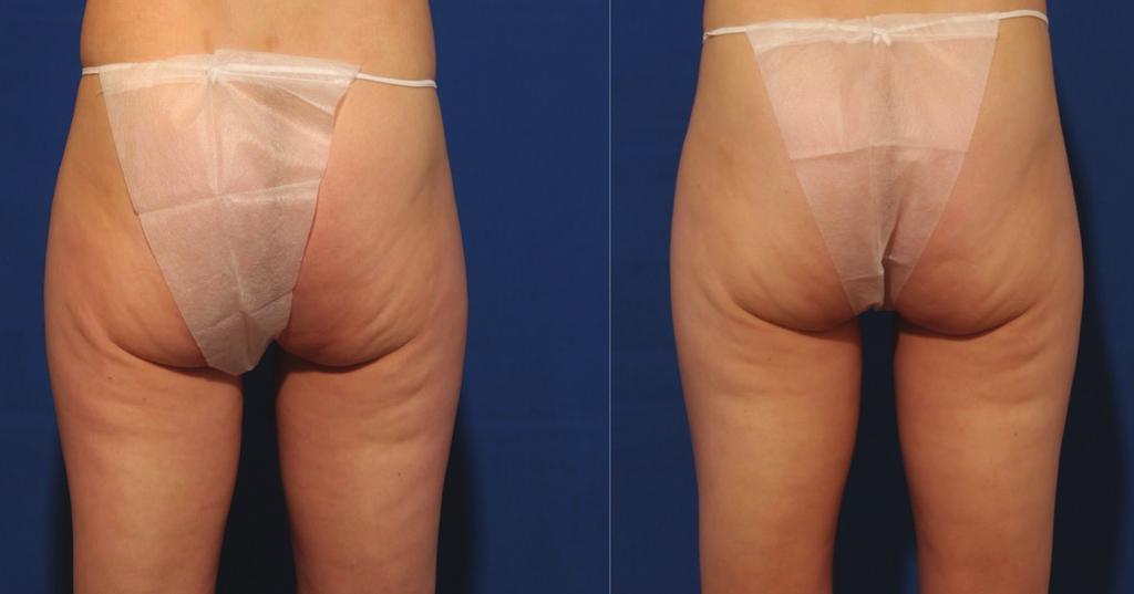 Figure 3: Pre-treatment for cellulite (left). Three months after four VelaShape III sessions, RF:3, IR: 1, V: 1, 30 minutes (right).