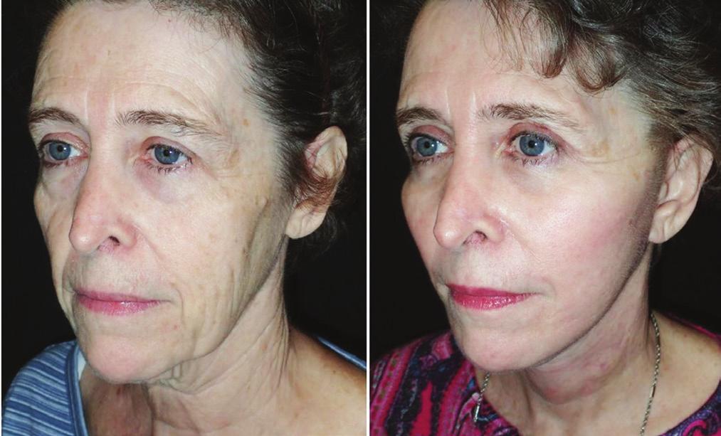With the CO2RE laser, I treat the central oval of the face with appropriate settings from mid to deep fusion and treat the undermined facelift flaps with a light to mid setting.