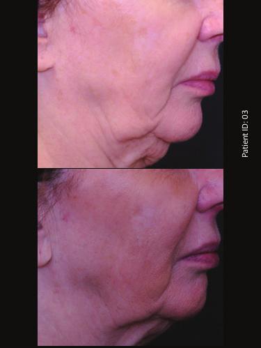 It also delivers fractional RF energy to the subcutaneous layer, enabling treatment of adipose tissue and the septae. Initially, the treatment was FDA cleared for reduction of facial wrinkles in 2010.