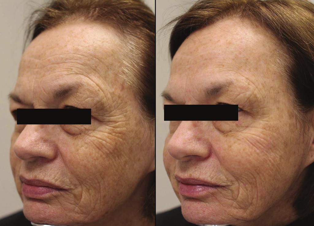 Treatment of diffuse facial pigmentation (melasma and post-inflammatory pigmentation). The PicoWay picosecond laser is an excellent system for a busy aesthetic practice.