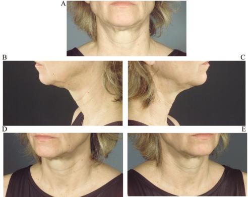 Figure 5. This 57-year-old woman is complaining of skin folds in the neck. She underwent neck lipoplasty 2 years ago.