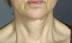 Figure 1. This 61-year-old woman is seeking rejuvenation of the face and neck.