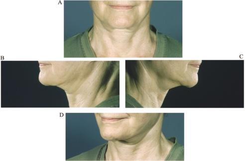 Figure 2. This 72-year-old woman is complaining about the appearance of her neck. She has had two previous face lifts, with the most recent 4 years ago. the resection.