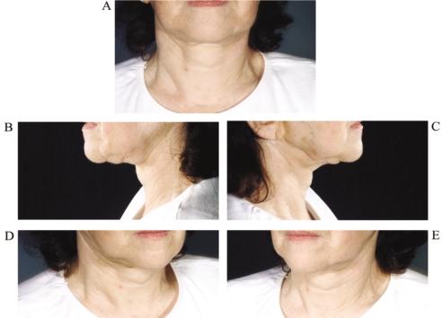 Figure 3. This 62-year-old woman wants improvement in the appearance of her neck. She had face and neck lift surgery 16 years ago with a history of skin slough in her left lower cheek and upper neck.