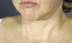 Figure 4. This 65-year-old woman is complaining of fullness in the neck.