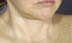 When I close the flap or put the subcutaneous tissue together, I can flatten the submental skin crease rather nicely, and