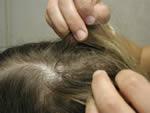 What are the signs and symptoms of head lice infestation? Tickling feeling of something moving in the hair. Itching, caused by an allergic reaction to the bites of the head louse.