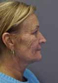 This procedure may be performed in isolation, or in combination with other facelift techniques.
