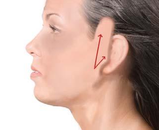 Similar longer-lasting results as a traditional facelift, but with a much faster recovery and less downtime.