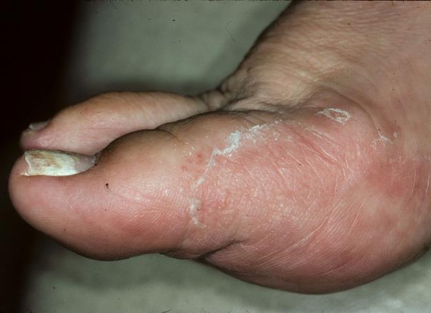 Skin scrapings from feet + nails