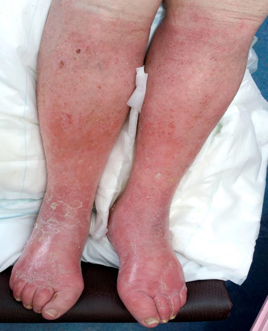 Lymphoedema skin complications