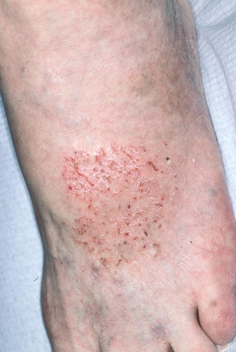 Lymphoedema skin complications Eczema / Dermatitis?