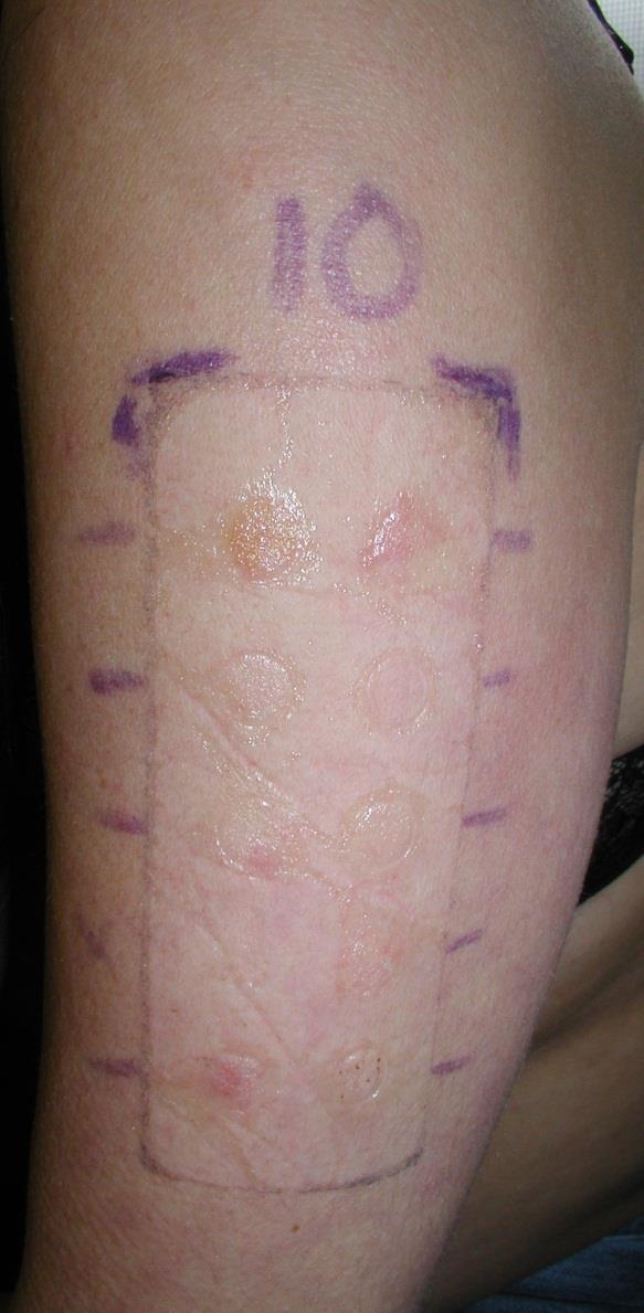 Contact allergic eczema Type IV allergic reaction Patch testing