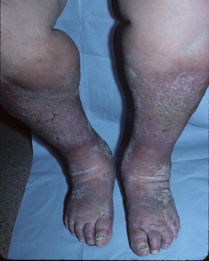 Lymphoedema and skin barrier: Emollients Wide range patient