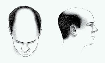 Figure 3 Figure 4 PATTERNS OF MALE BALDNESS Before selecting an appropriate treatment for male pattern baldness, your surgeon will consider the extent of your hair loss, how your remaining hair is