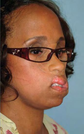 In both the United States and abroad AAFPRS members assist those who suffer from facial deformities which may be secondary to trauma, birth disorders, tumors, or other causes.