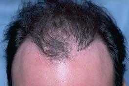 5. For micrografts and follicular units that are pointing in the wrong direction, or that have been placed too