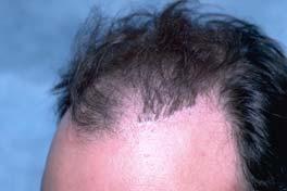 It is best to complete the removal phase of the repair before additional hair is taken from the donor area.