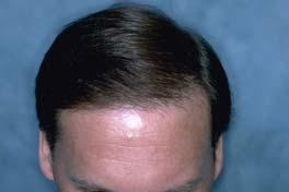These grafts became visible as his hairline receded.