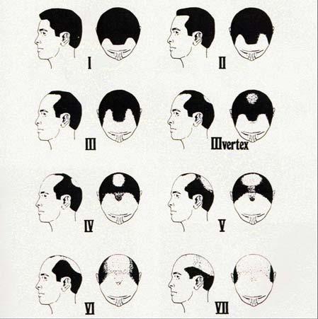 thinning crown, enlarge and eventually coalesce to form a large bald area that covers the entire front, top and crown (vertex) of the scalp.
