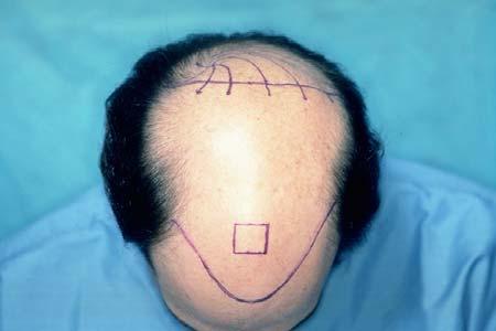 Figure 5B. Regions of the scalp. Note the predominately forward direction of hair markings as one crosses over the vertex transition point anteriorly.