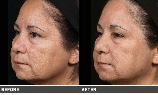 Frequently Asked Questions Do I need an ablative laser treatment? Ablative laser treatment is used for the removal of pigmentation and the deep penetration of the dermis.