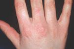 Soap several times 4 Skin burns / stings as a sign of early ICD