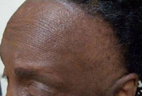 Hair and scalp disorders in women of African descent, A. Salam et al. 29 topical immunomodulators, dapsone, methotrexate or mycophenolate mofetil.