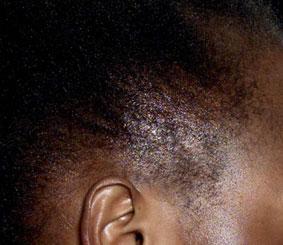 30 Hair and scalp disorders in women of African descent, A. Salam et al.