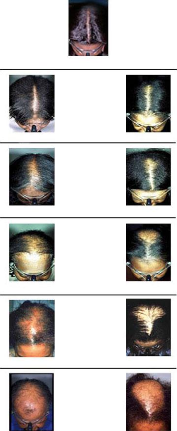 24 Hair and scalp disorders in women of African descent, A. Salam et al. 0 (TE), for example, a higher number of telogen hairs will be pulled out (increased telogen count).
