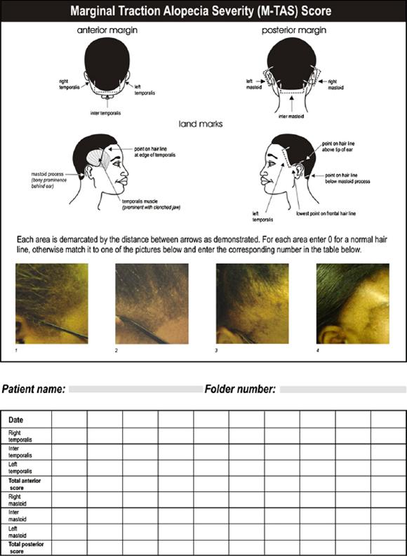 Hair and scalp disorders in women of African descent, A. Salam et al. 25 Fig 6. The Marginal Traction Alopecia Severity Score. Reprinted from Khumalo et al., 37 with permission from Wiley-Blackwell.
