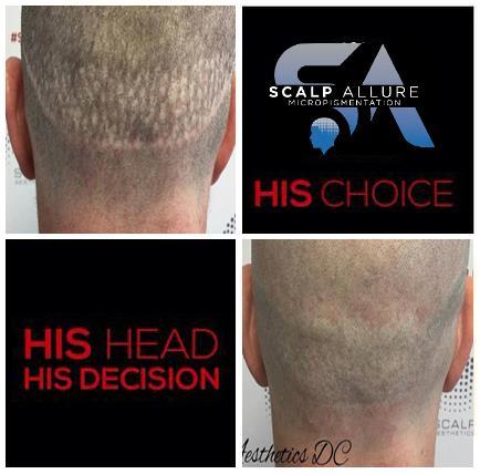 HAIR TRANSPLANT SCARS The Scalp Allure technique is a highly advanced form of scalp micropigmentation procedure, not only covering scars, but giving the illusion of a fuller head of hair either by
