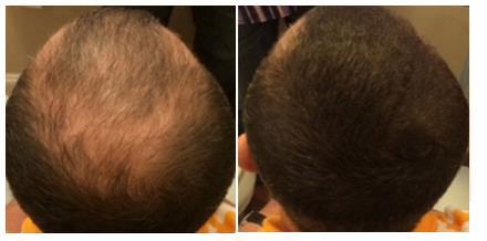 HAIR TRANSPLANT COMBINATION As well as hiding general baldness and thinning, we use our scalp micropigmentation technique to cover scars created by hair restoration surgery.
