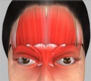 Unit 1: Introduction - Foreheadplasty Muscles of Forehead Foreheadplasty, also