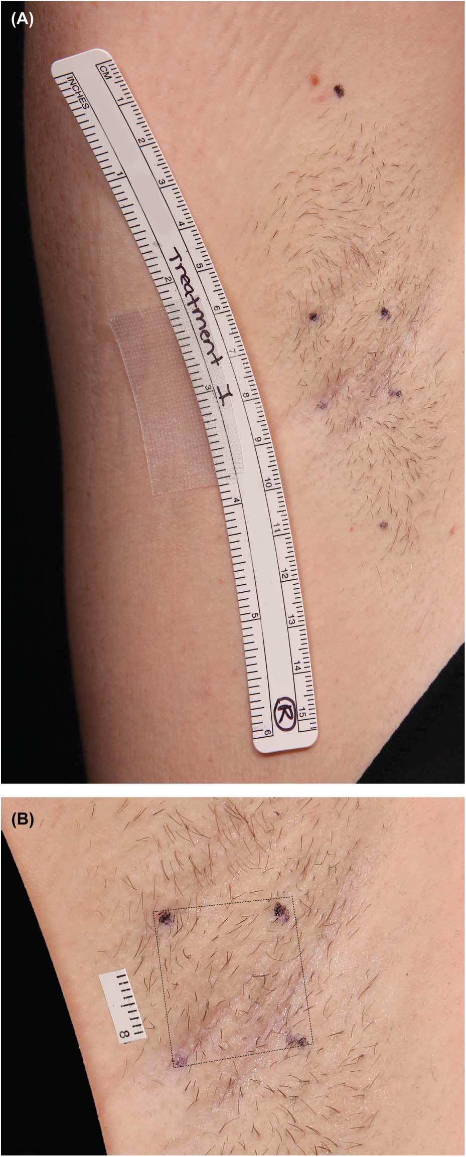 BRAUER ET AL Treatments and Study Visits The treatments were provided by a noninvasive device with integrated surface cooling of the skin that delivers focused microwave energy to the lower part of
