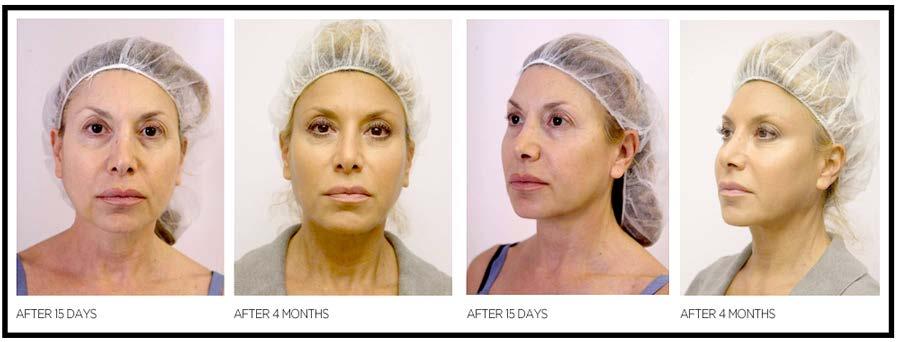 SILHOUETTE SOFT THREAD FACELIFT This treatment has been all over the news in the last 12 months.