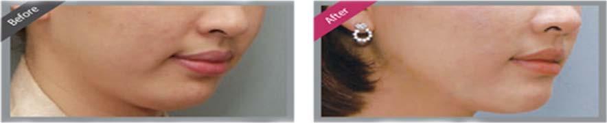 PDO SOFT THREAD FACE LIFTS ELIONCE AND V SOFT THREADS PDO Thread lifts are the alternative to