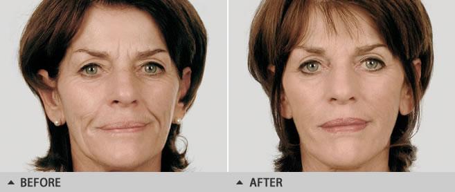 Effects lasts two years at which time it can be repeated. You can read more about Scupltra my article entitled Art of looking younger on my website (http://botox.hornchurchhealthcare.co.uk).