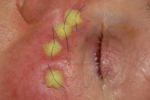 The appearance of the Prolene stitches and sponge bolsters at the completion of surgery The needles are passed away from the eye and are brought out through the skin below the eyelids and tied over