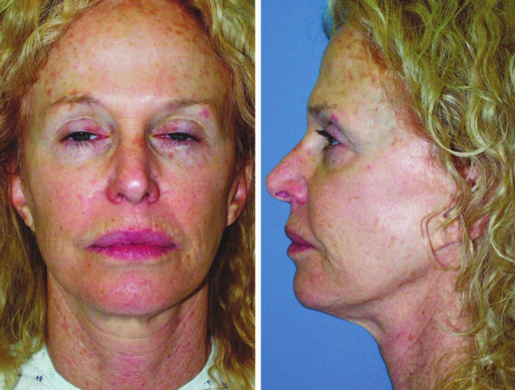 Volume 121, Number 1 Midface Aging Fig. 9. The same patient s appearance in June of 2004, 13 years after the initial cosmetic facial surgery. Fig. 10.