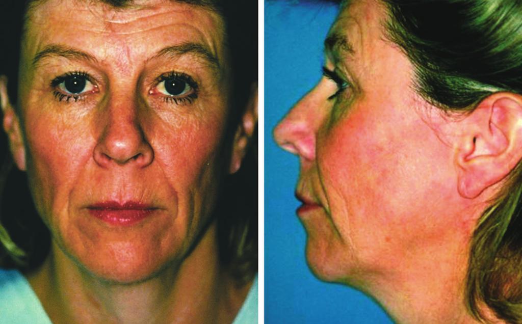 Plastic and Reconstructive Surgery January 2008 nasolabial fold in both the front and lateral photographs is significantly decreased, and the improvement of the lid-cheek junction appearance as a
