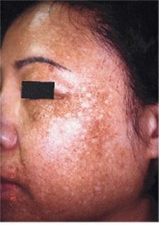 BROWN SPOTS HIGH LEVEL OF
