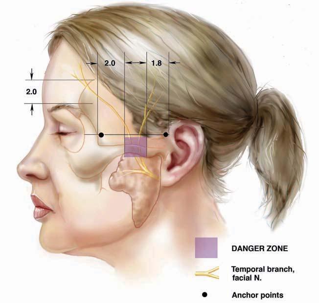 DANGER ZONE Temporal branch, facial N. Anchor points Figure 3.