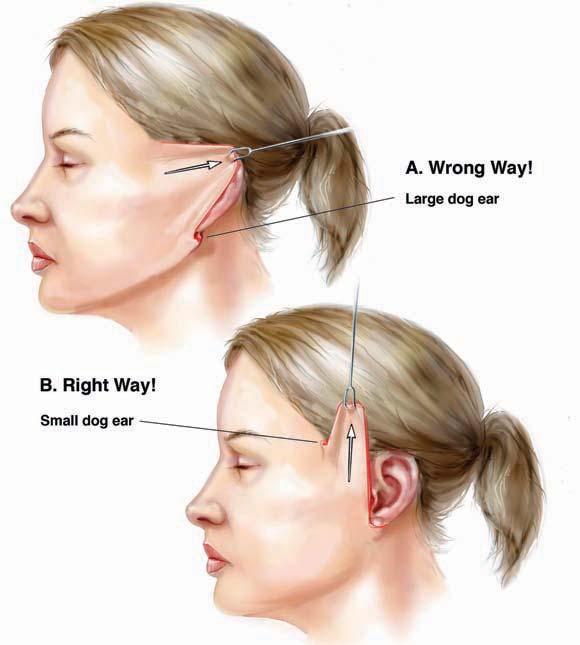 A. Wrong Way! Large dog ear B. Right Way! Small dog ear Figure 6. A, A lateral redraping of the skin will produce tension and flattening of the face, and a dog ear will be created below the earlobe.