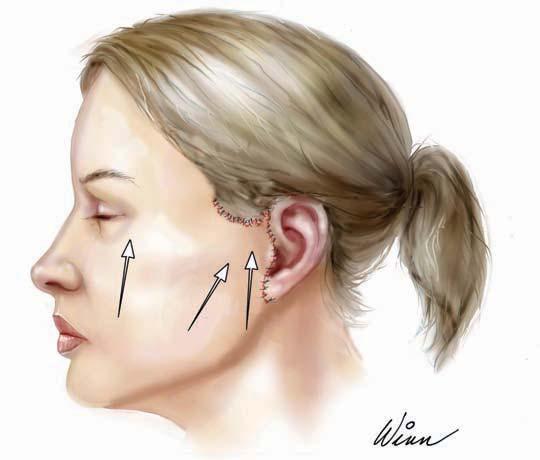 Excess skin trimmed around natural temporal hairline A B Earlobe folds on itself as flap is elevated Skin resected to allow ear to return to natural appearance Figure 8.