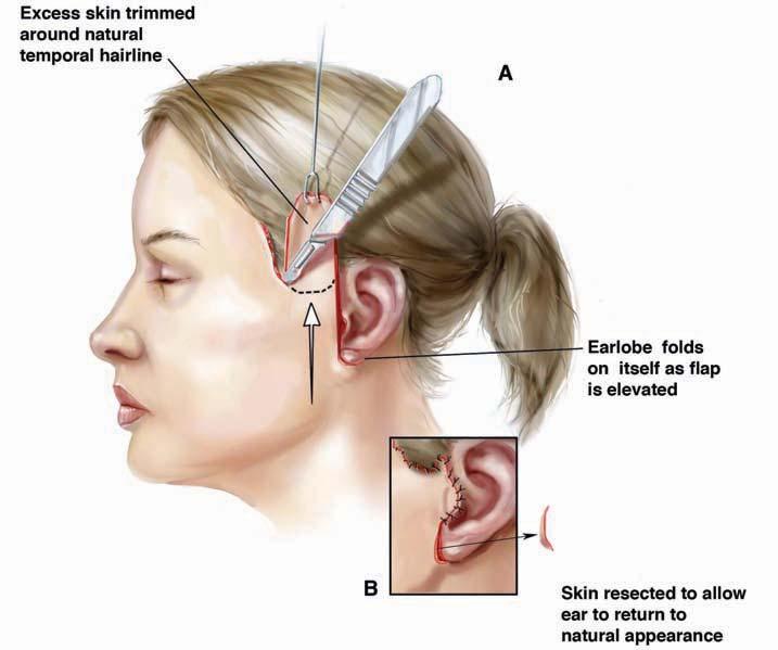 The temporal hairline incision is mandatory in any vertical face lift technique to avoid unnatural raising of the sideburns. There is virtually no skin resection in the preauricular region.
