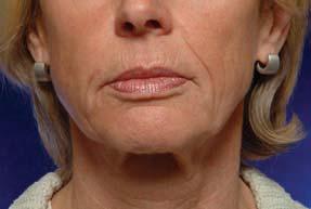 the mouth, upper lip rhytids, marked nasolabial folds, and